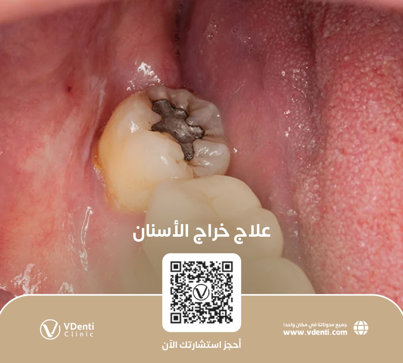 علاج خراج الأسنان