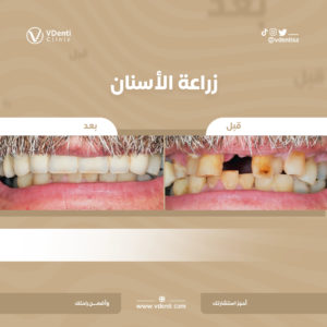 تركيب الأسنان