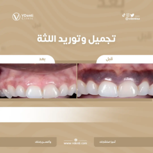 تنظيف اللثة