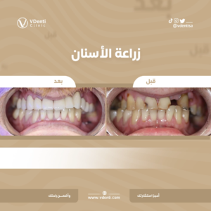 زراعة الأسنان الفورية