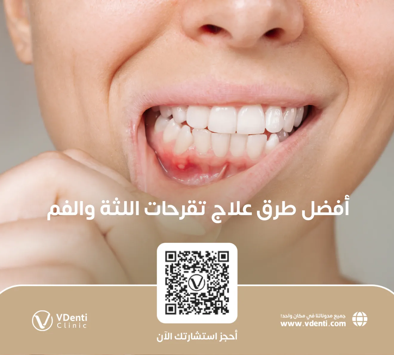 أفضل طرق علاج تقرحات اللثة والفم