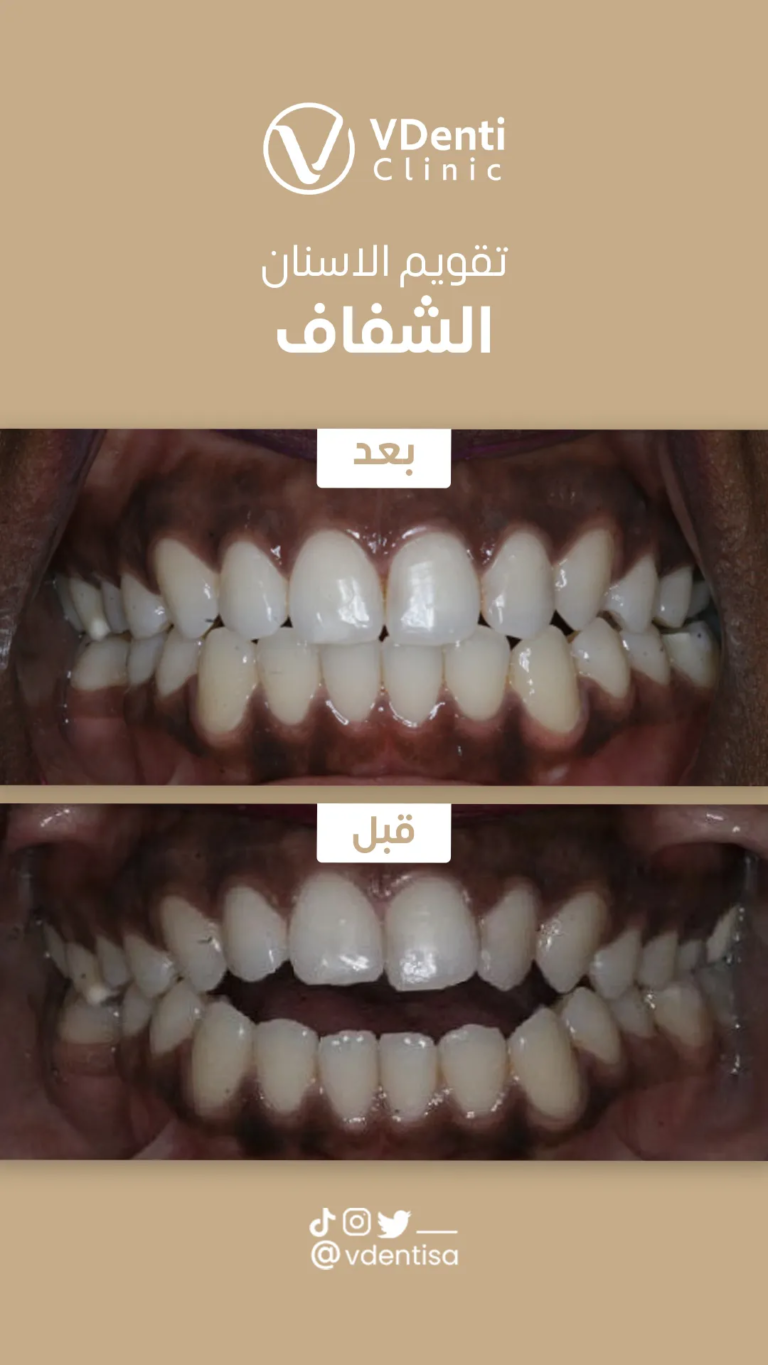 تقويم الاسنان الشفاف