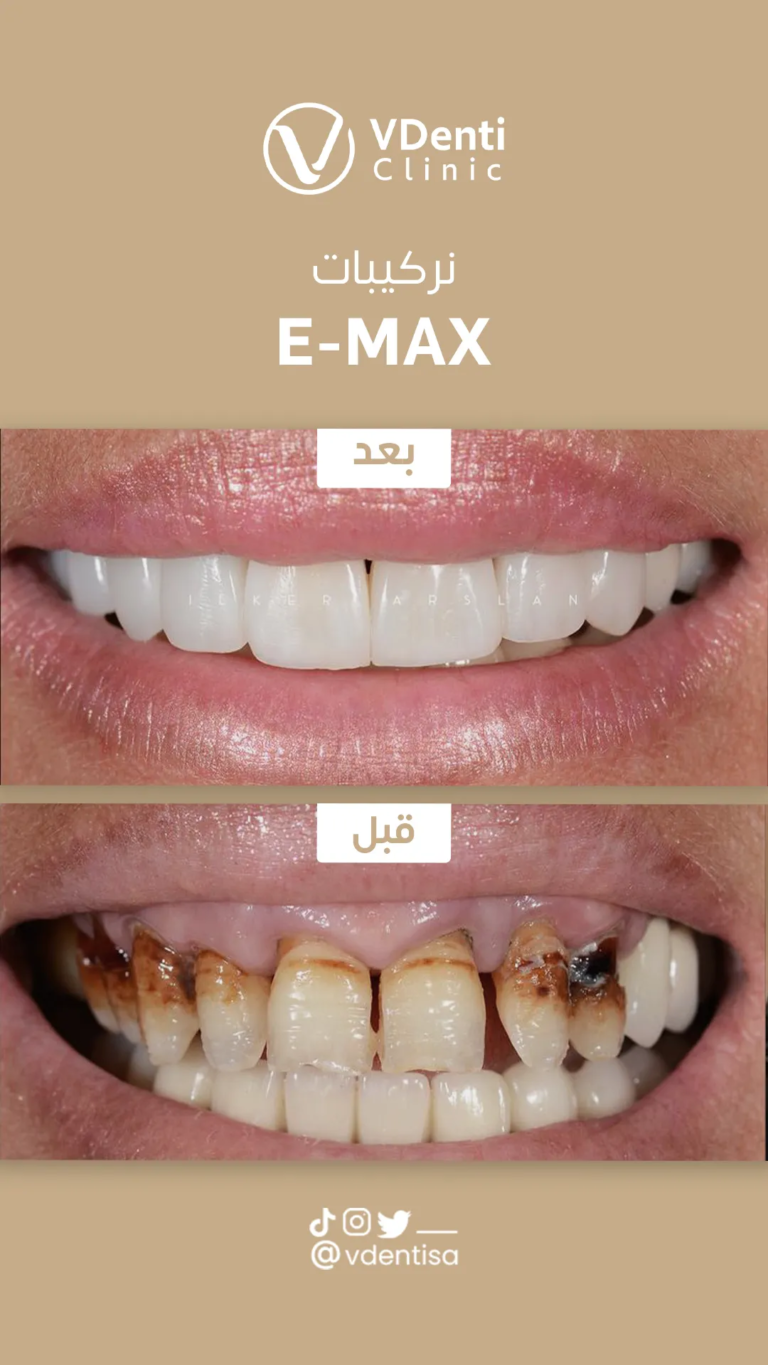 تركيبة الايماكس
