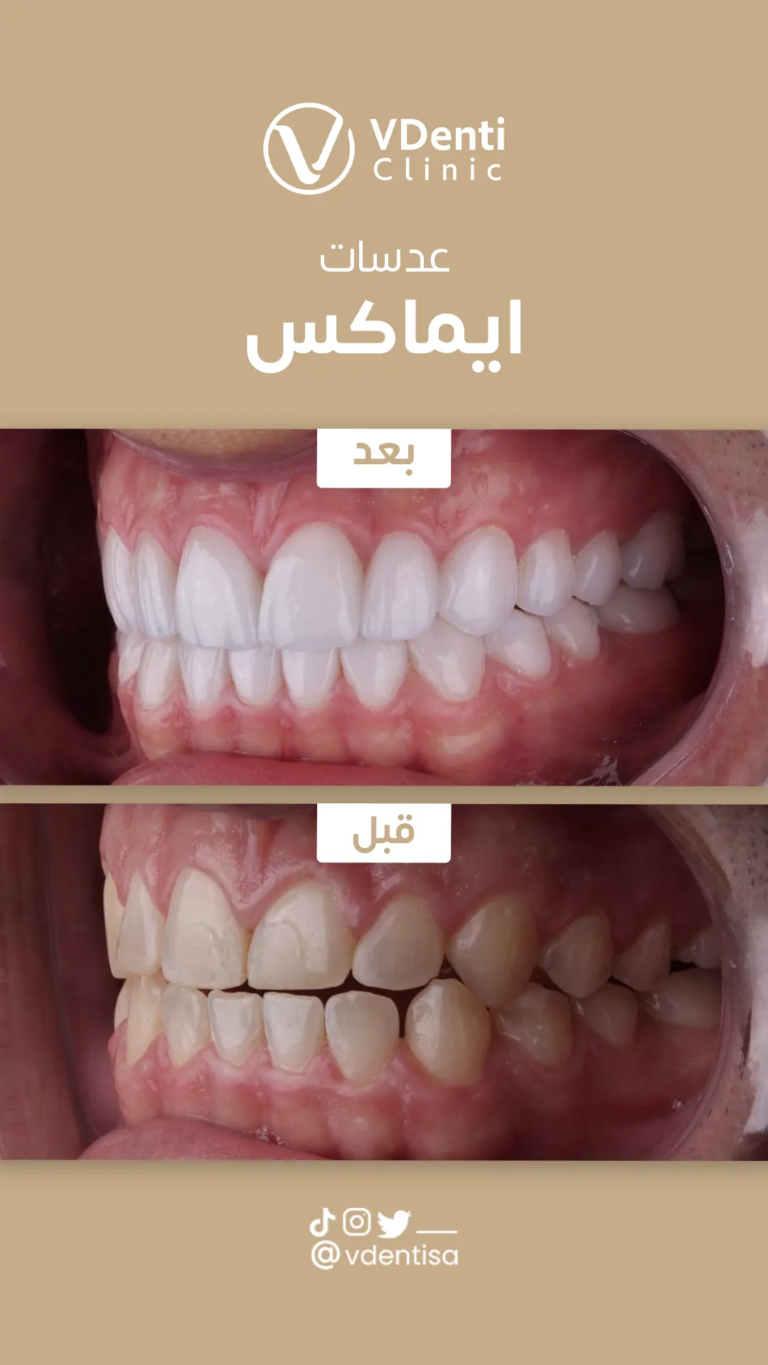 عدسات ايماكس
