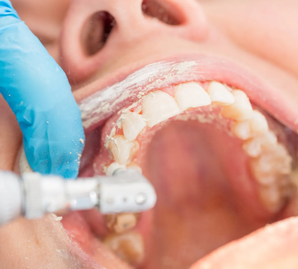 علاجات سابقة للأسنان