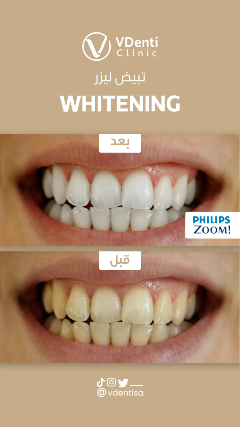 تبييض الأسنان بالليزر
