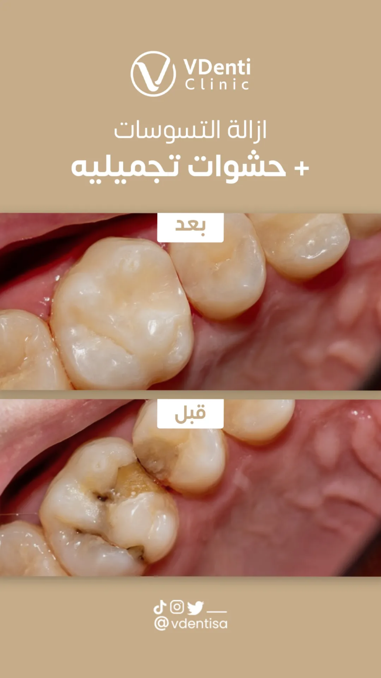 علاج تسوس الاسنان