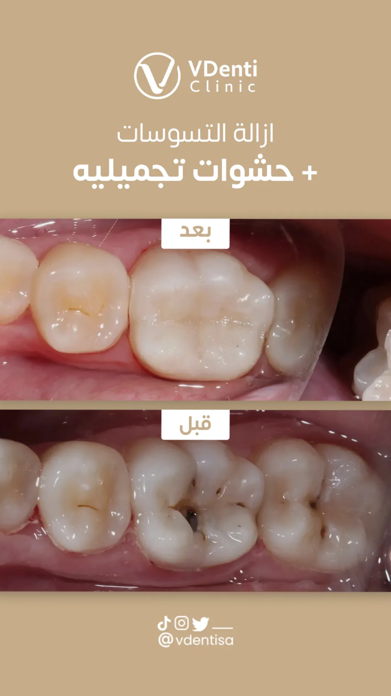 حشوات الأسنان