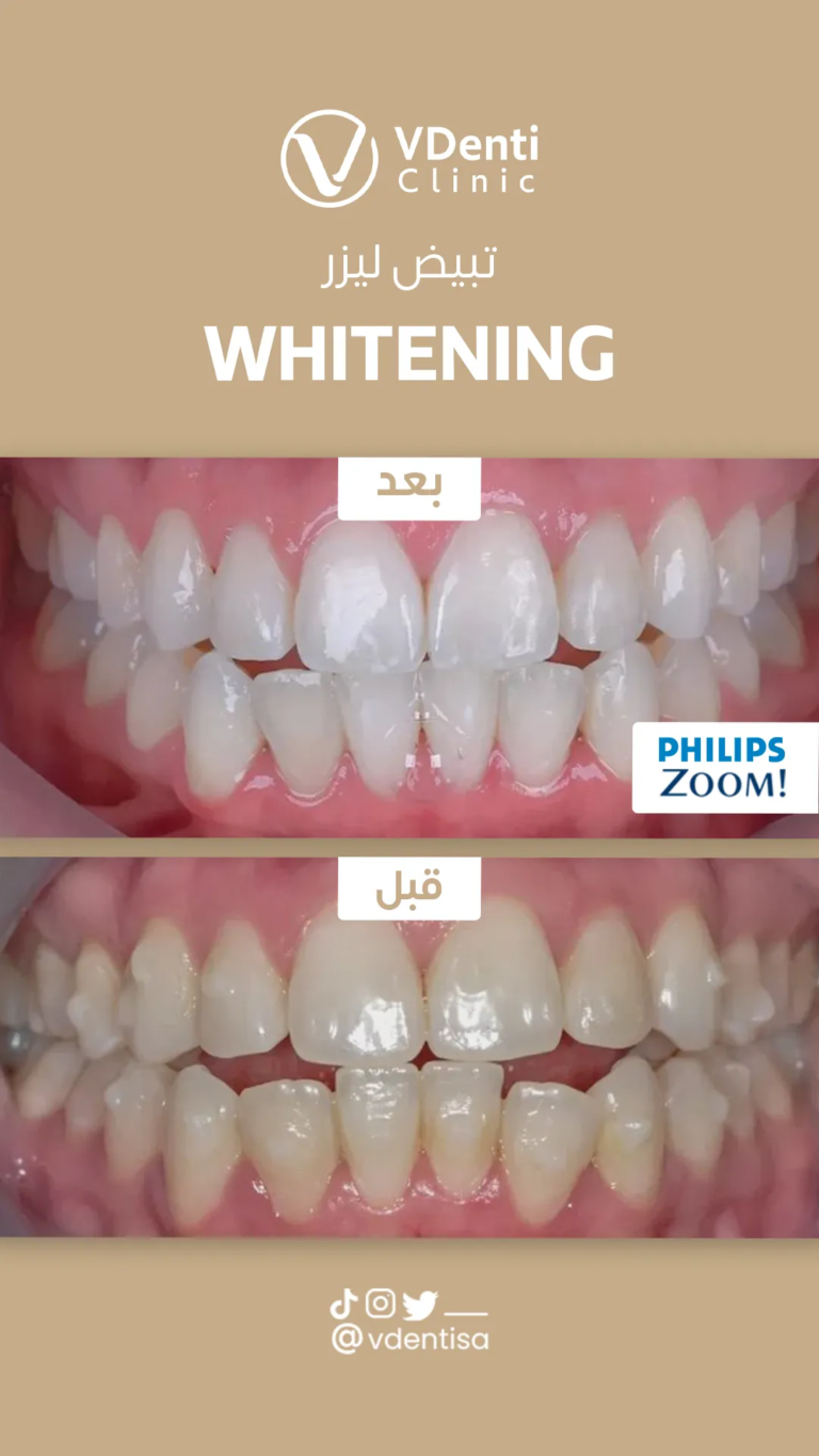 تبييض الأسنان
