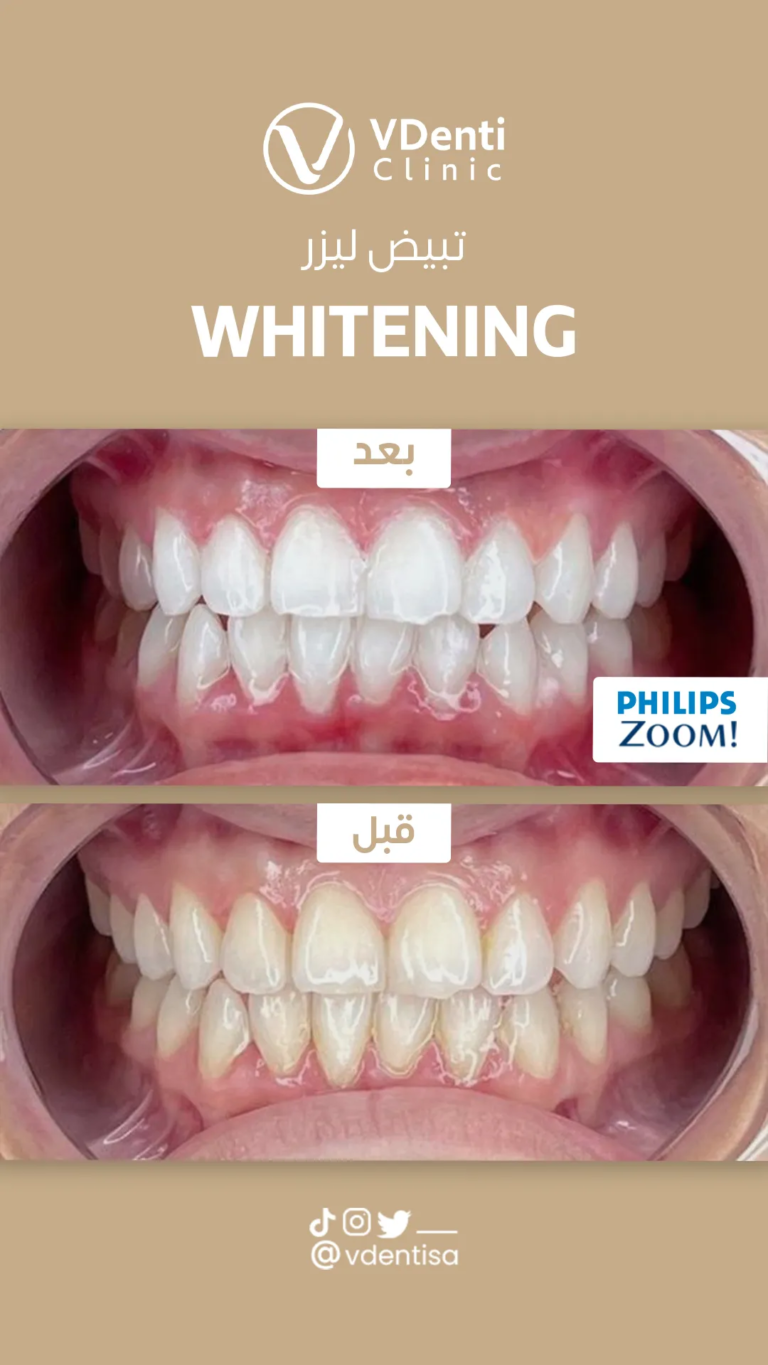 تبييض الاسنان قبل وبعد
