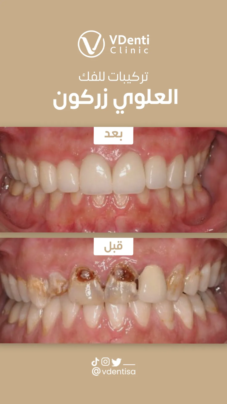 تركيبات الزيركون