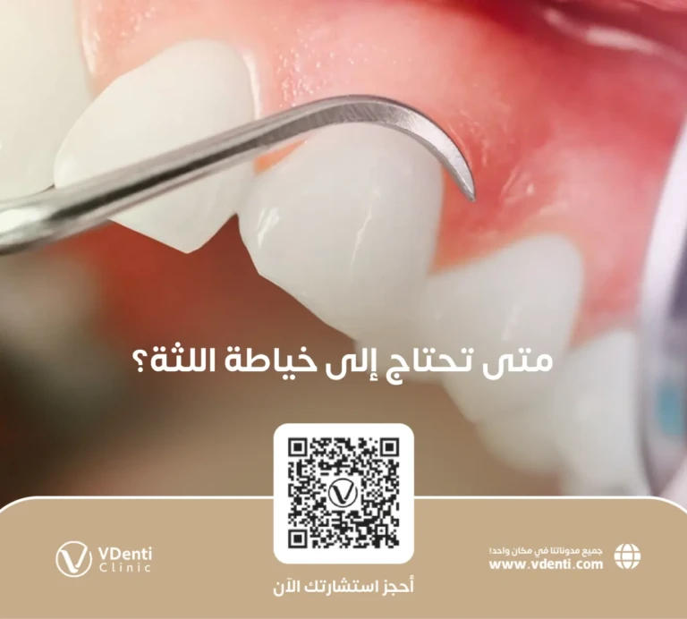 متى تحتاج إلى خياطة اللثة؟