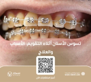 تسوس الأسنان مع التقويم