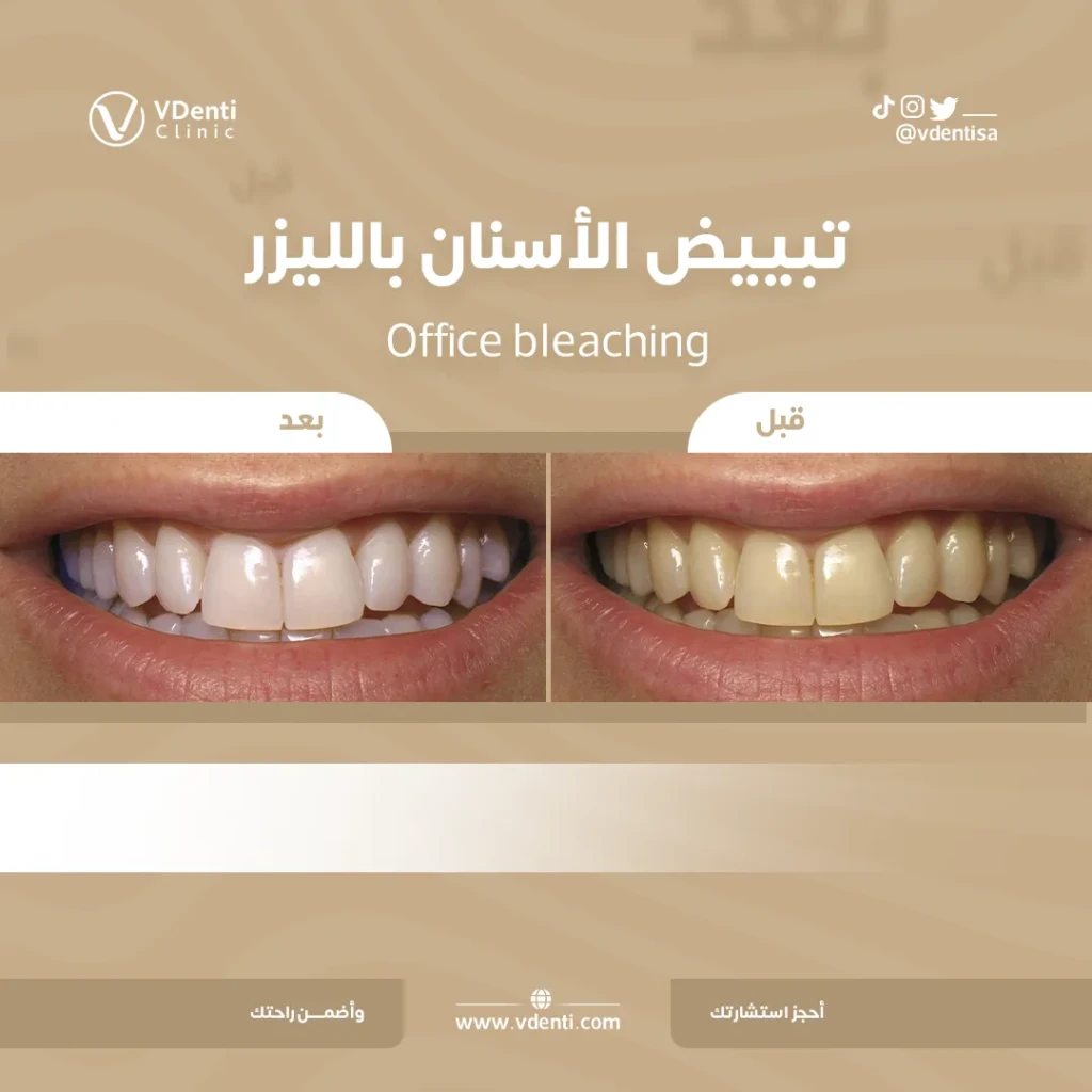تنظيف الأسنان قبل وبعد