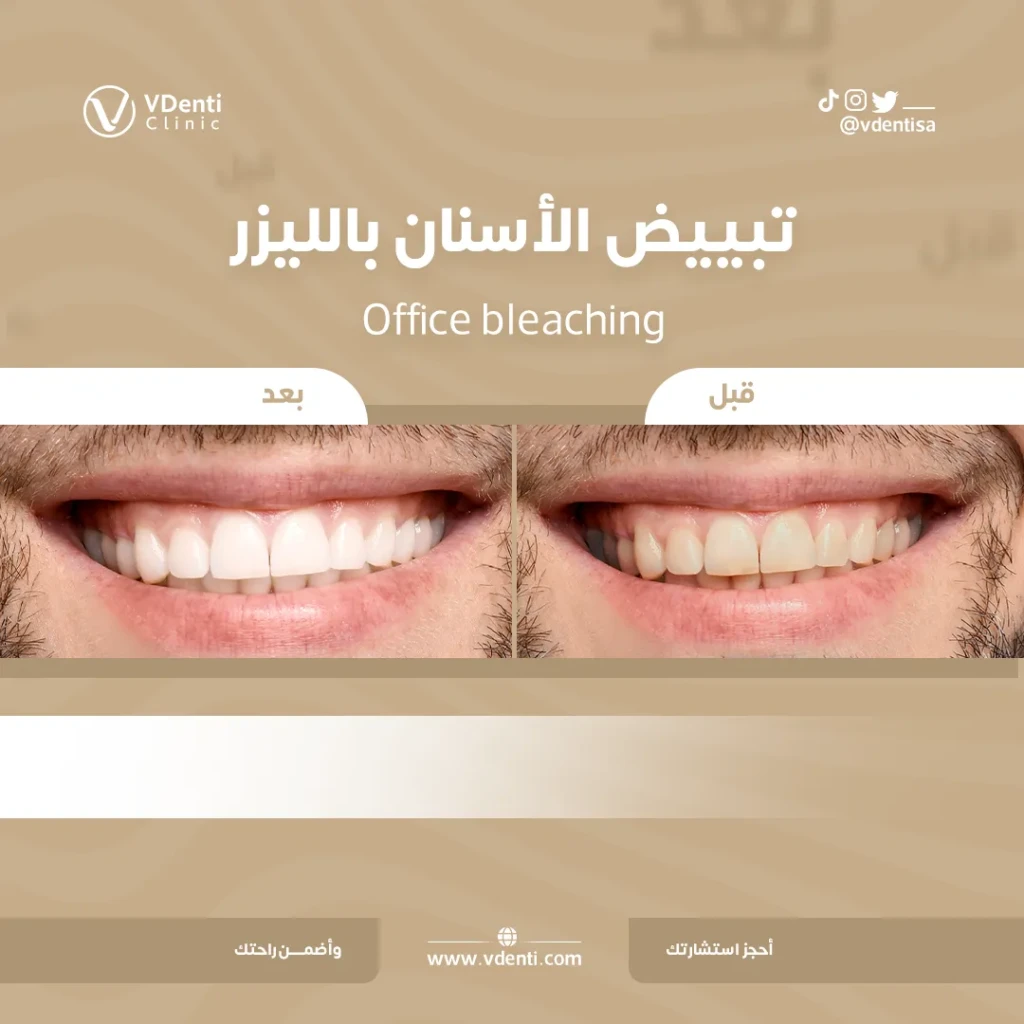 عيادة تنظيف اسنان بجدة