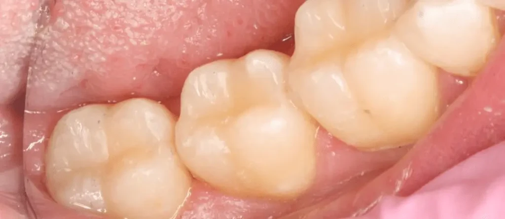 تجميل الاسنان بالحشوات​