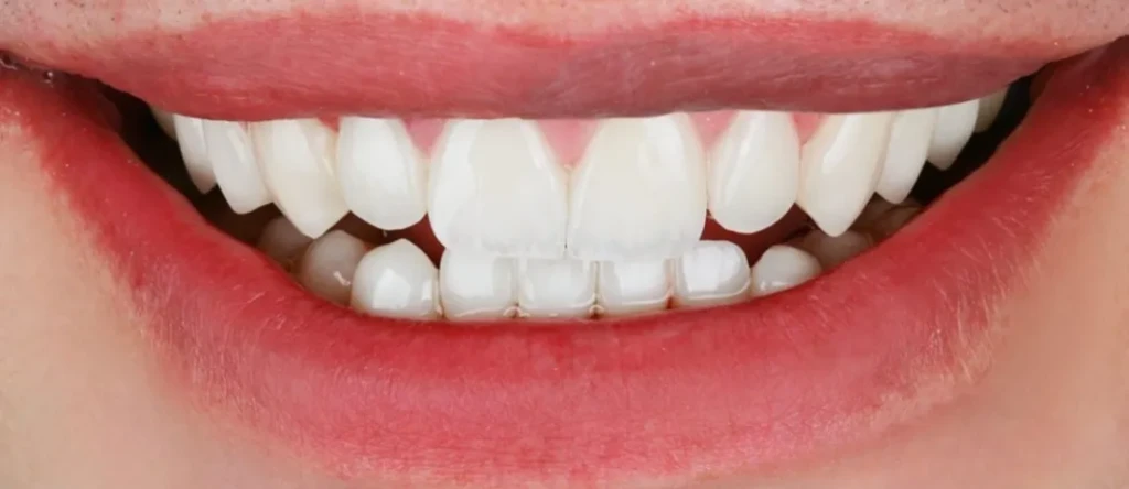 تجميل الاسنان بالفينير​