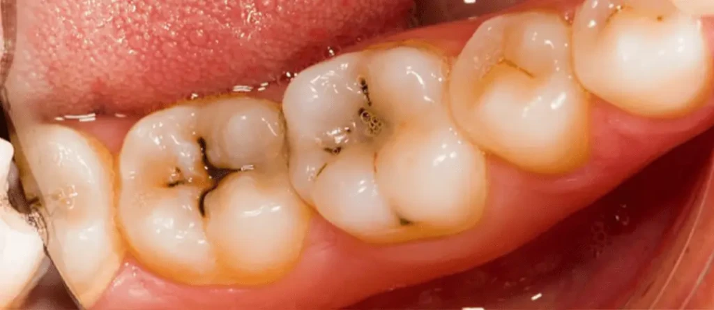 تسوس العاج