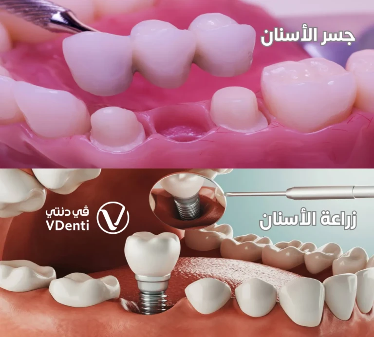 الفرق بين جسر الاسنان والزراعة