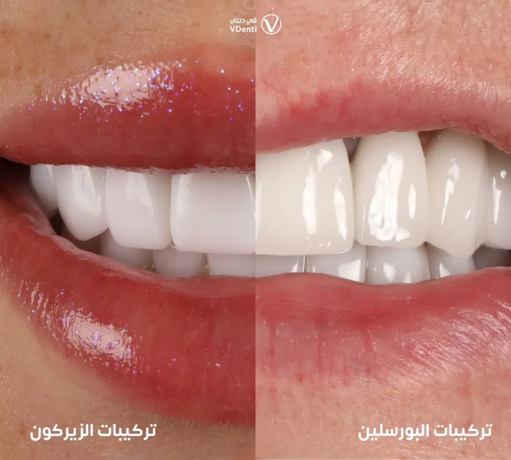 الفرق بين تركيبات الزيركون والبورسلين