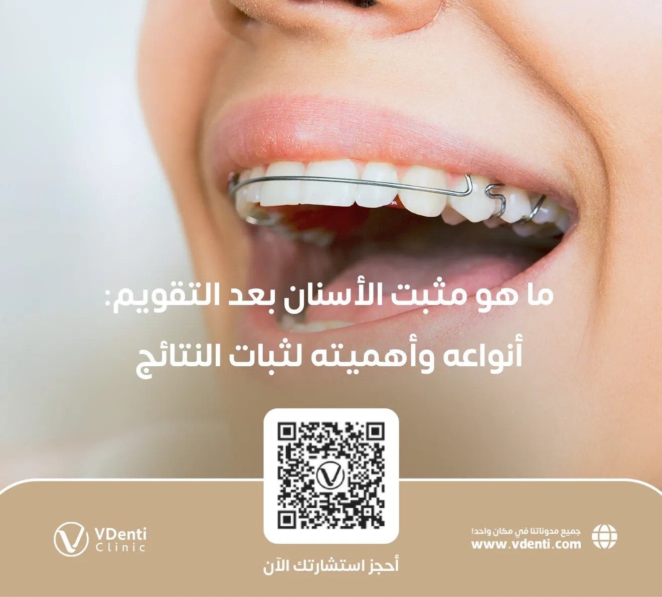 مثبت الأسنان بعد التقويم