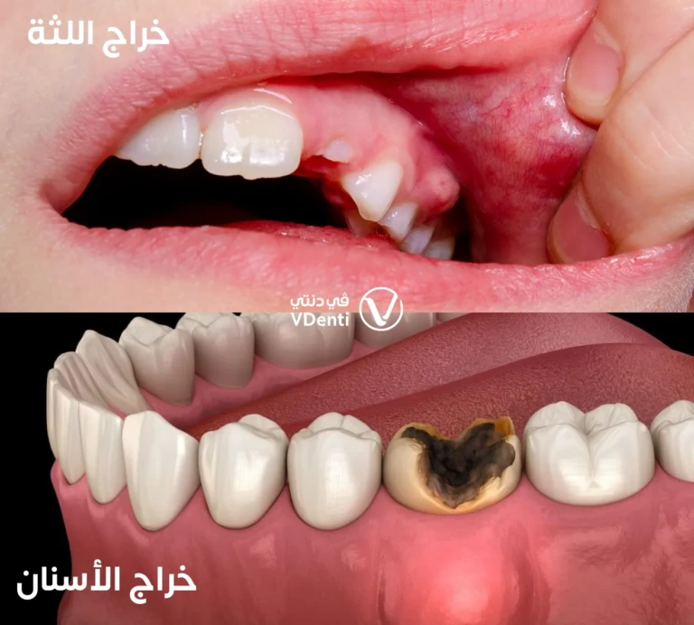 الفرق بين خراج اللثة وخراج الأسنان