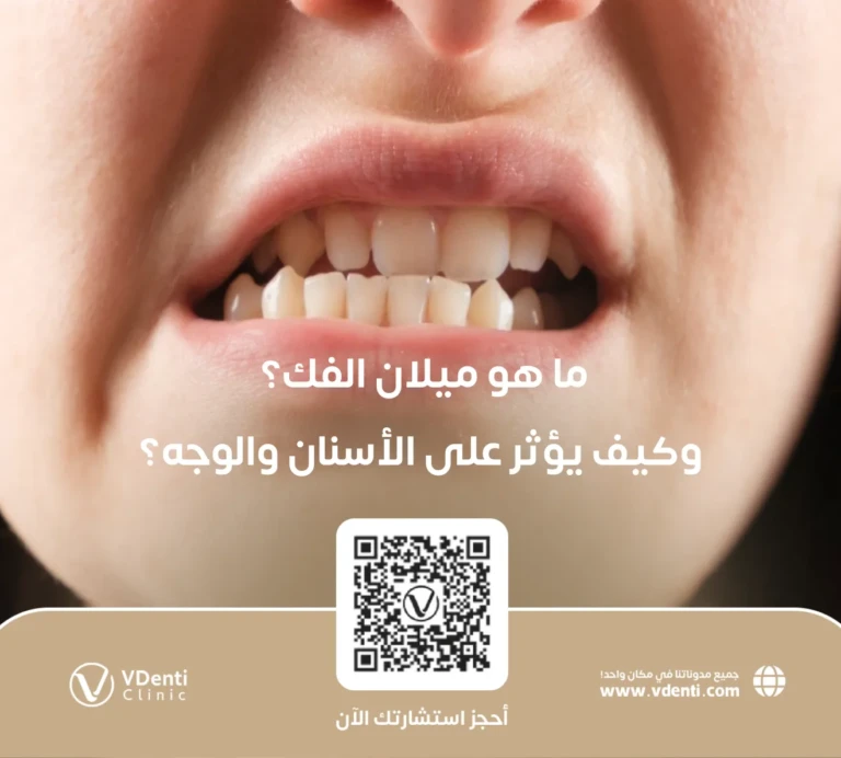 ميلان الفك