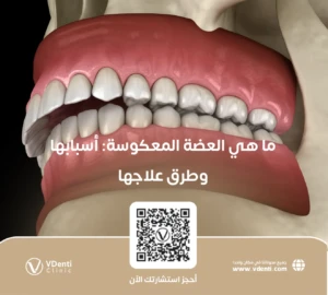 ما هي العضة المعكوسة