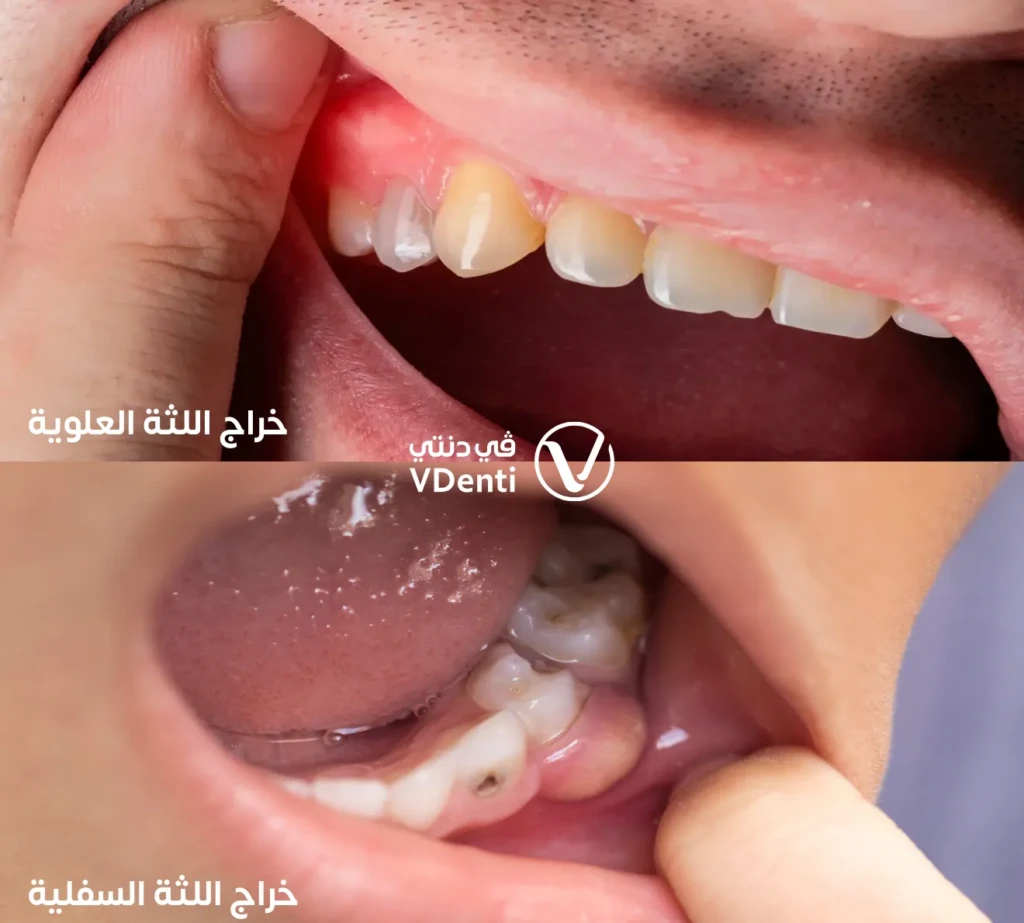 الفرق بين خراج اللثة السفلية والعلوية