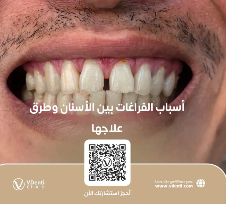 أسباب الفراغات بين الأسنان وطرق علاجها