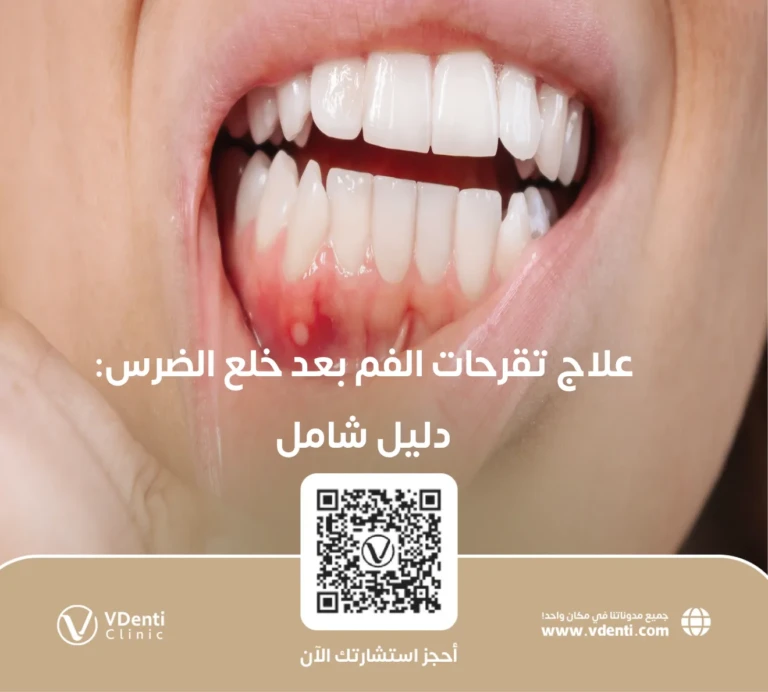 علاج تقرحات الفم بعد خلع الضرس
