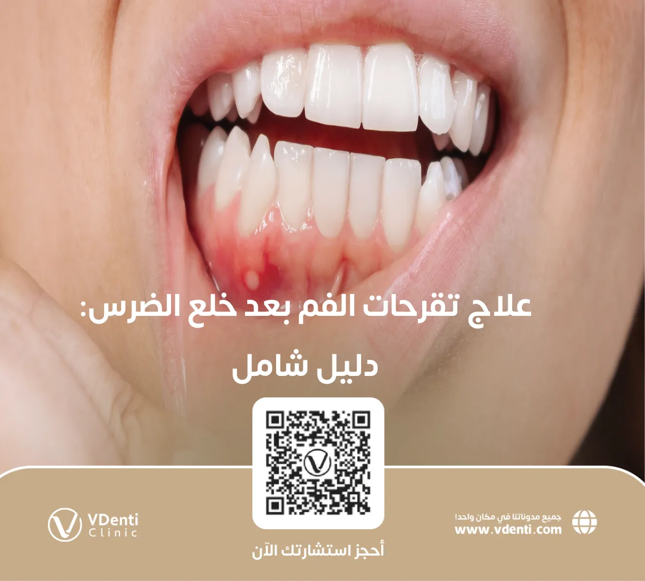 علاج تقرحات الفم بعد خلع الضرس