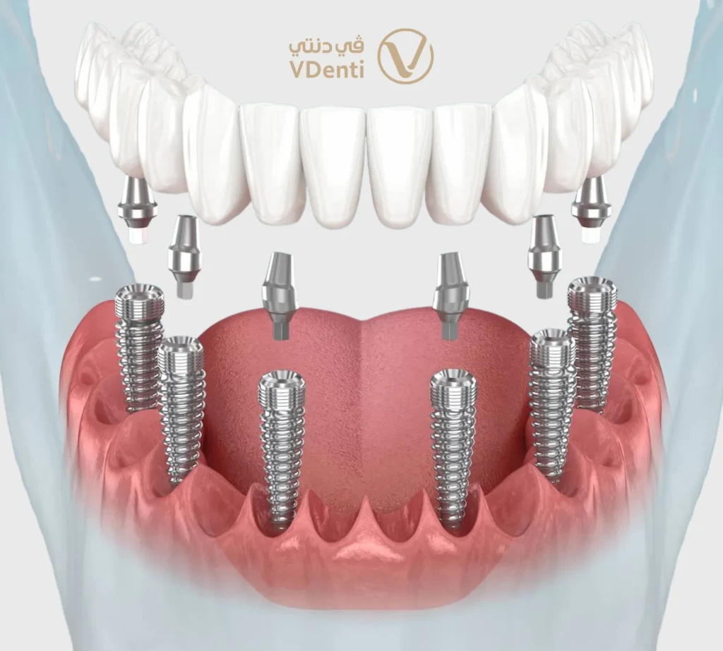 الأطقم المدعومة بالزرعات