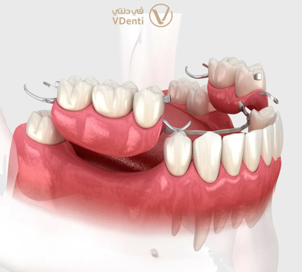 أطقم الأسنان الجزئية