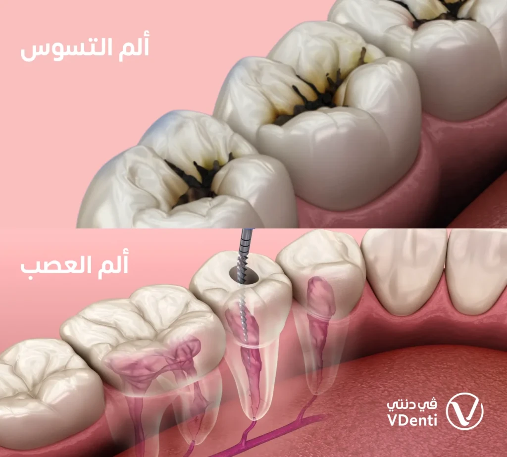 الفرق بين ألم التسوس وألم العصب