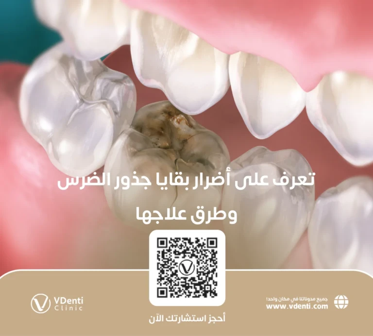 أضرار بقايا جذور الضرس