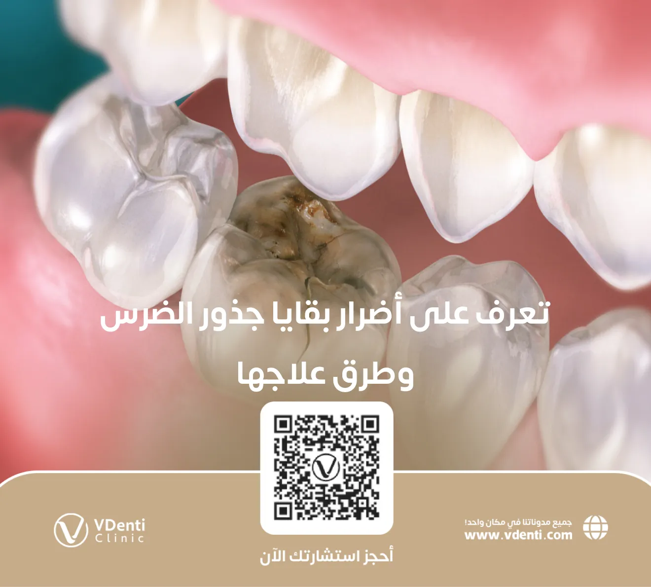 أضرار بقايا جذور الضرس