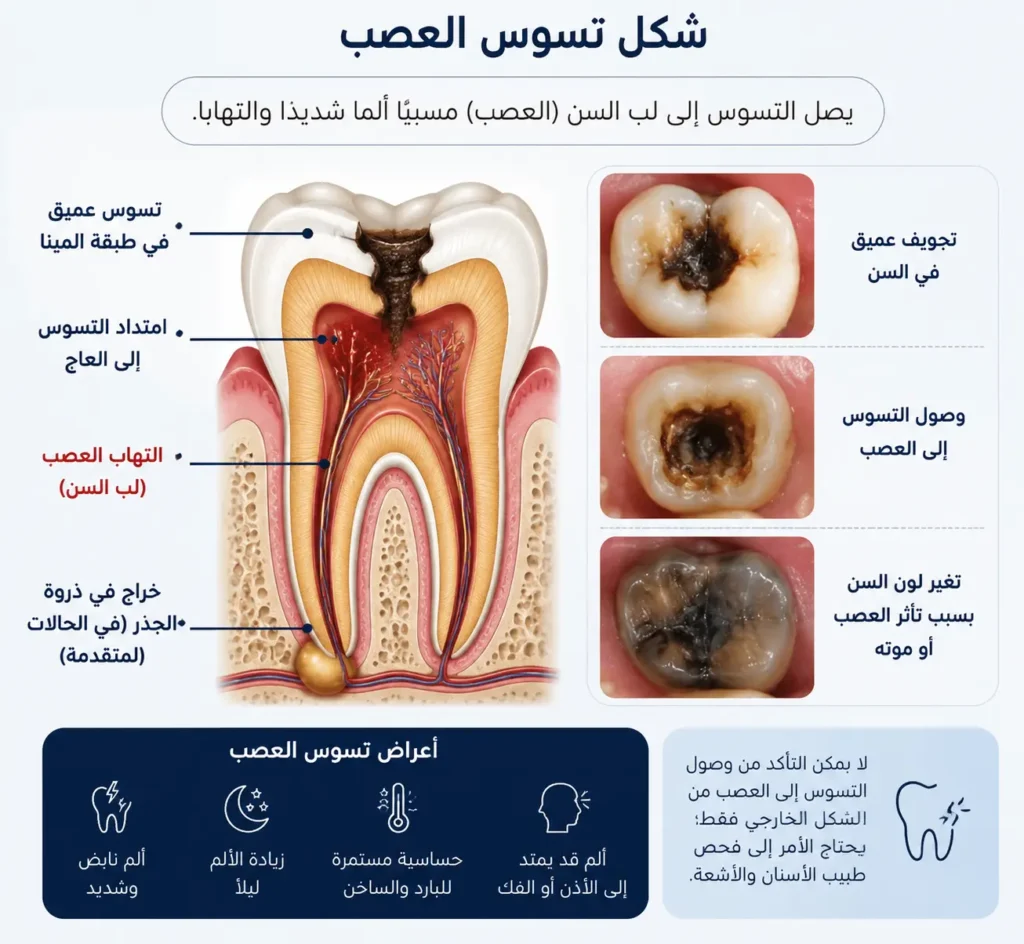 شكل تسوس العصب