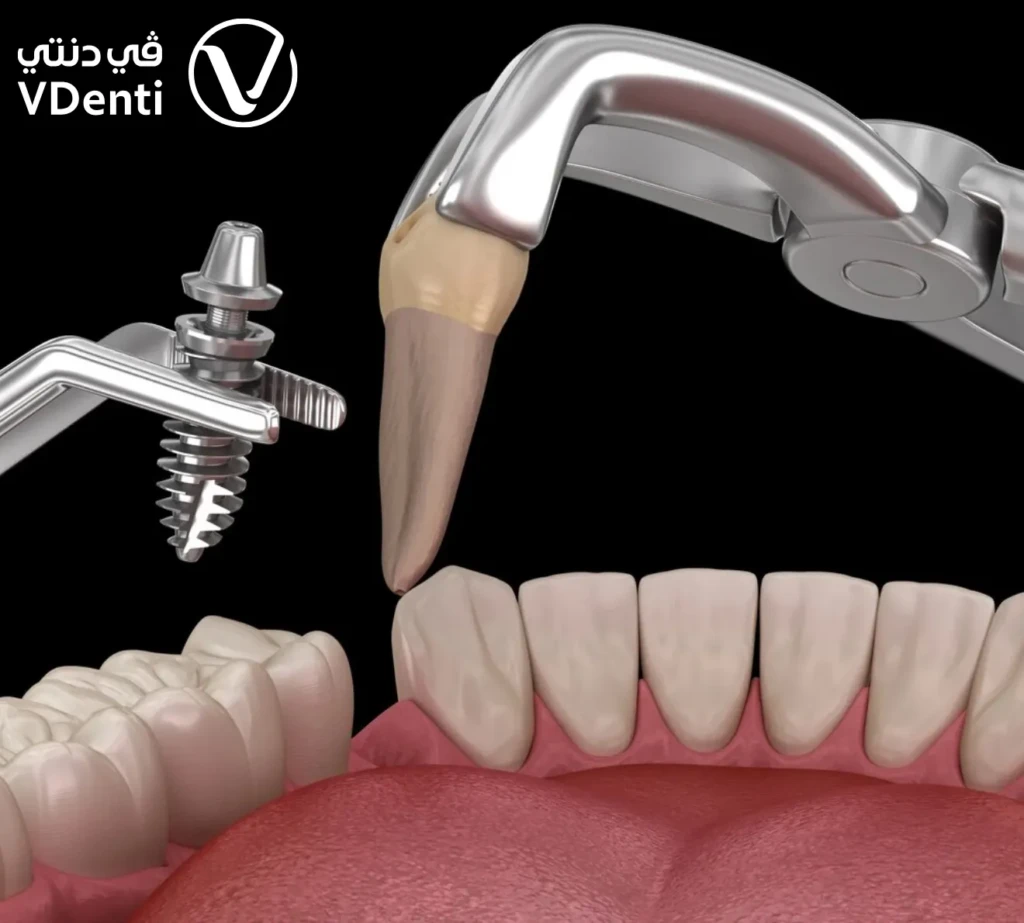 الزراعة الفورية