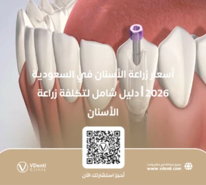أسعار زراعة الأسنان