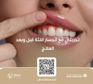 انحسار اللثة