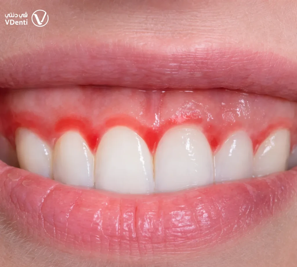 التهاب اللثة الفطري