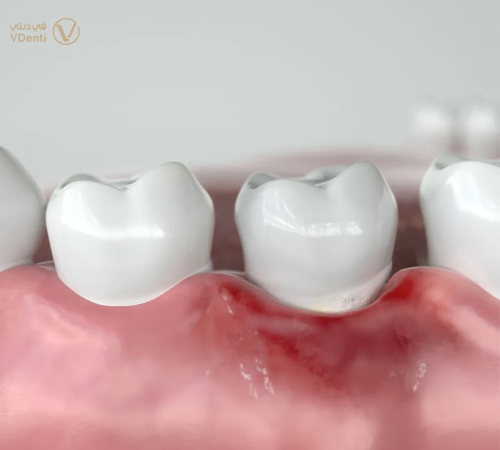 التهاب اللثة المرتبط بالتغيرات الهرمونية