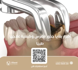 أضرار بقايا جذور الضرس