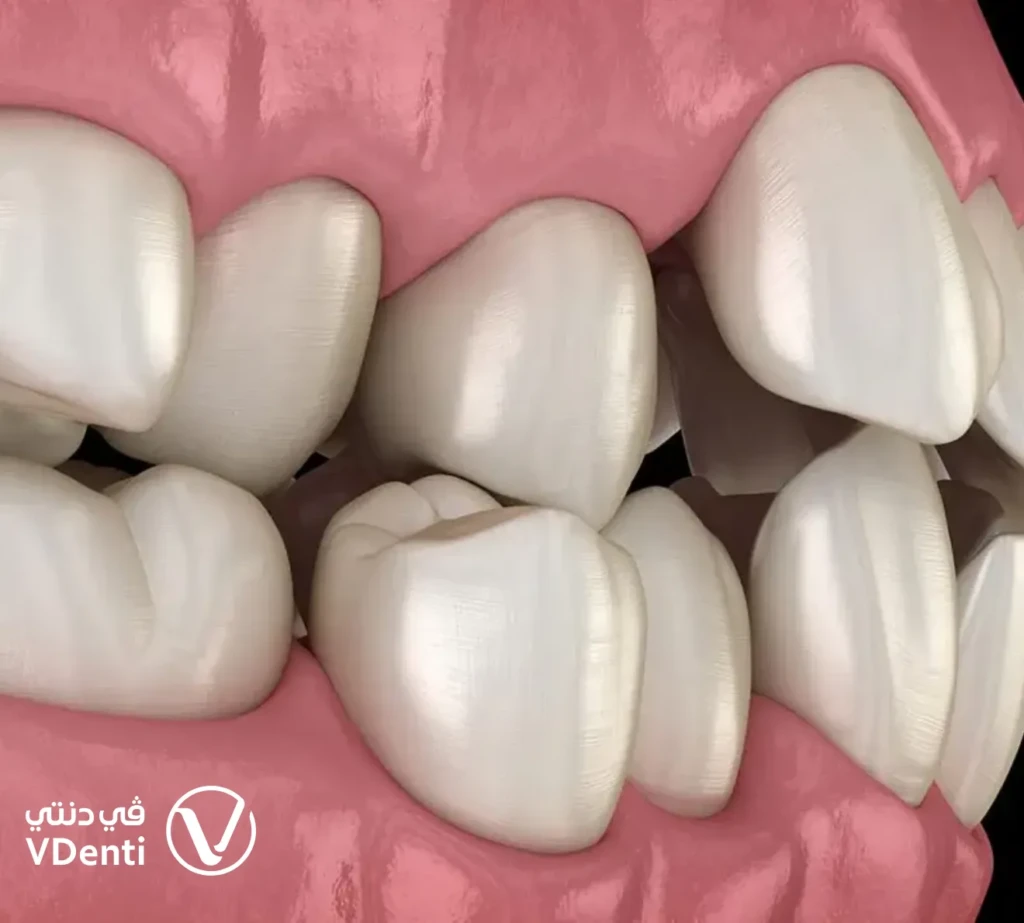 أسباب بروز الفك العلوي