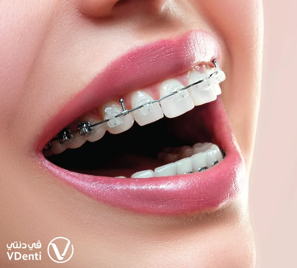 التقويم السيراميكي