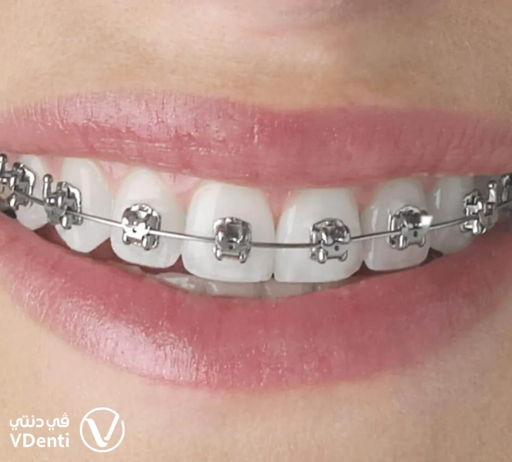 تقويم الأسنان المعدني