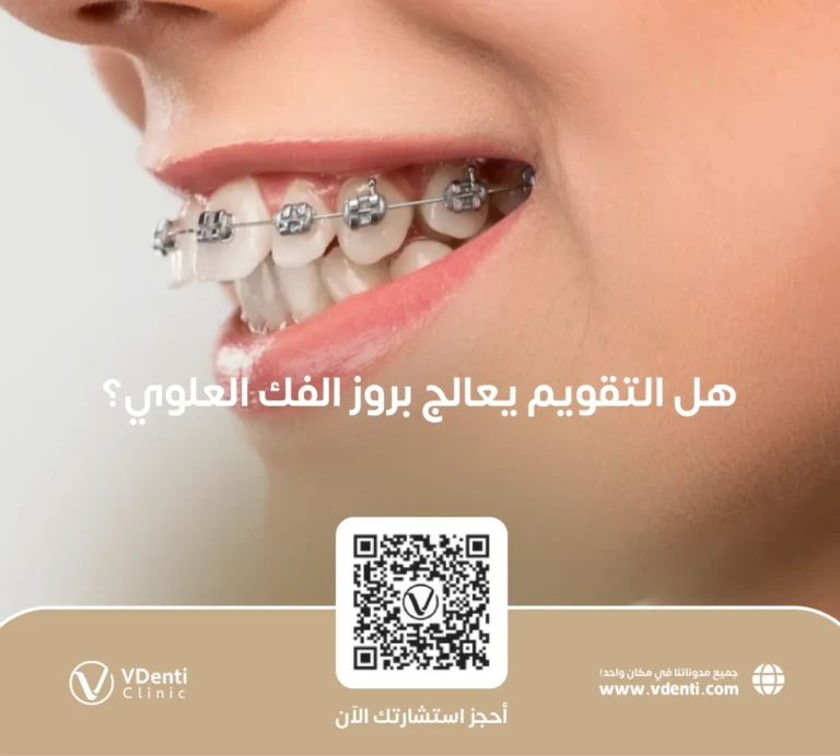 هل التقويم يعالج بروز الفك العلوي