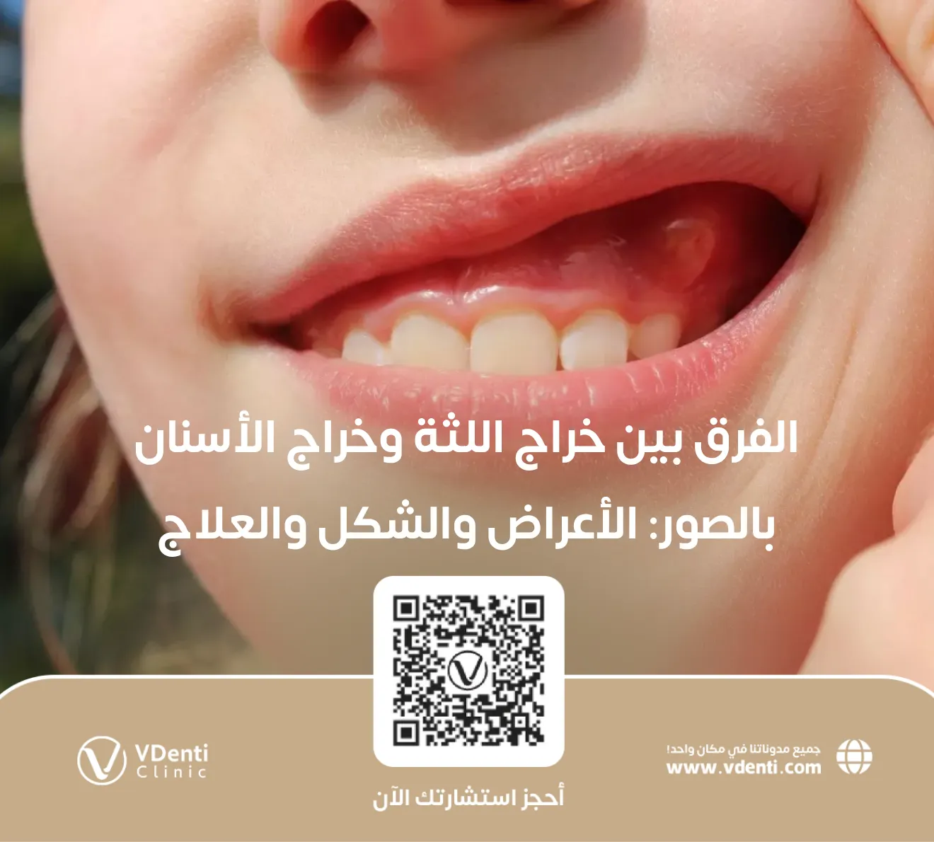 الفرق بين خراج اللثة وخراج الأسنان بالصور