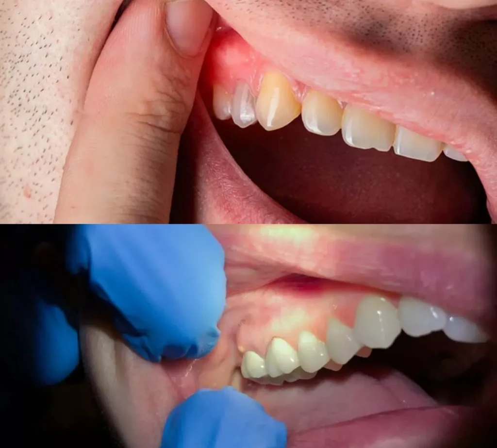 الفرق بين خراج اللثة وخراج الأسنان بالصور